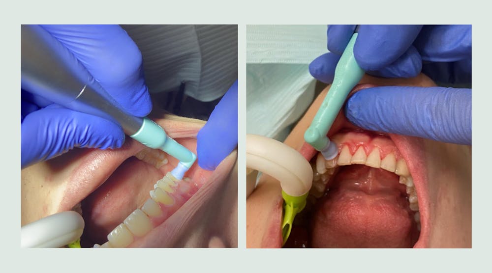 Left: PetitePearl accessing posterior teeth easily; right: PetitePearl cup adapting subgingivally