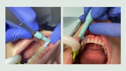 Left: PetitePearl accessing posterior teeth easily; right: PetitePearl cup adapting subgingivally Left: PetitePearl accessing posterior teeth easily; right: PetitePearl cup adapting subgingivally