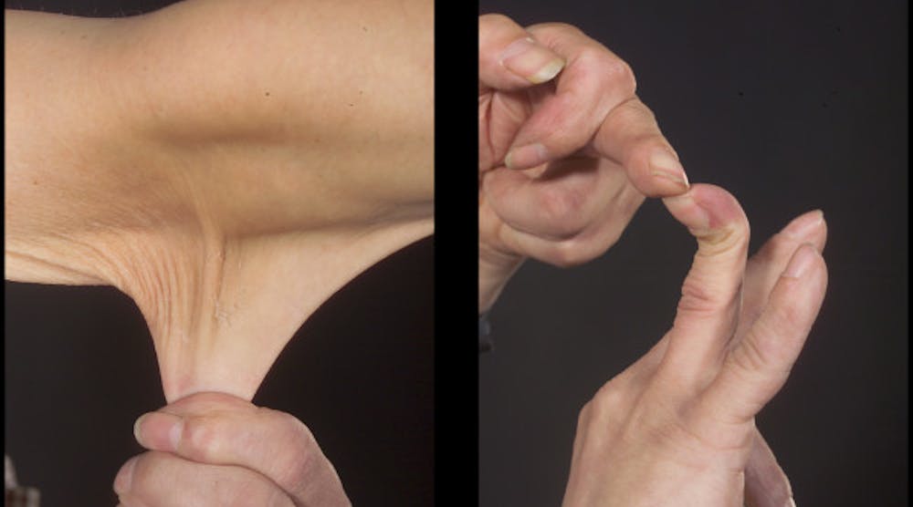 Figure 1: (left) depicts the elasticity of the skin with profound flexibility; (right) demonstrates joint mobility.