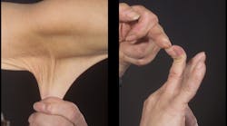 Figure 1: (left) depicts the elasticity of the skin with profound flexibility; (right) demonstrates joint mobility.
