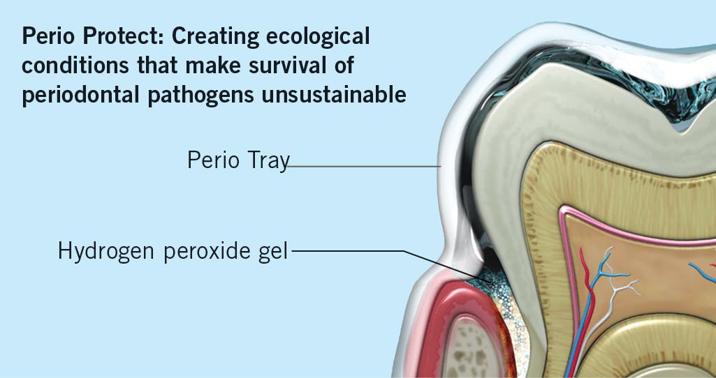 Figure 2: Graphic representation of the Perio Protect method