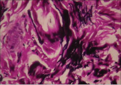 Figure 3: Elastin fibers in the dermis continue to grow and expand. Stain is Verhoeff-Van Gieson. The altered elastin fibers (black) in the image are likely from a hypermobility type of EDS, with the TNX mutation. The enlarged/thickened elastin is believed to alter anesthesia and promote the elastic quality of the skin.