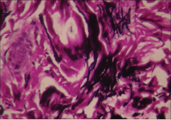 Figure 3: Elastin fibers in the dermis continue to grow and expand. Stain is Verhoeff-Van Gieson. The altered elastin fibers (black) in the image are likely from a hypermobility type of EDS, with the TNX mutation. The enlarged/thickened elastin is believed to alter anesthesia and promote the elastic quality of the skin. Figure 3: Elastin fibers in the dermis continue to grow and expand. Stain is Verhoeff-Van Gieson. The altered elastin fibers (black) in the image are likely from a hypermobility type of EDS, with the TNX mutation. The enlarged/thickened elastin is believed to alter anesthesia and promote the elastic quality of the skin.