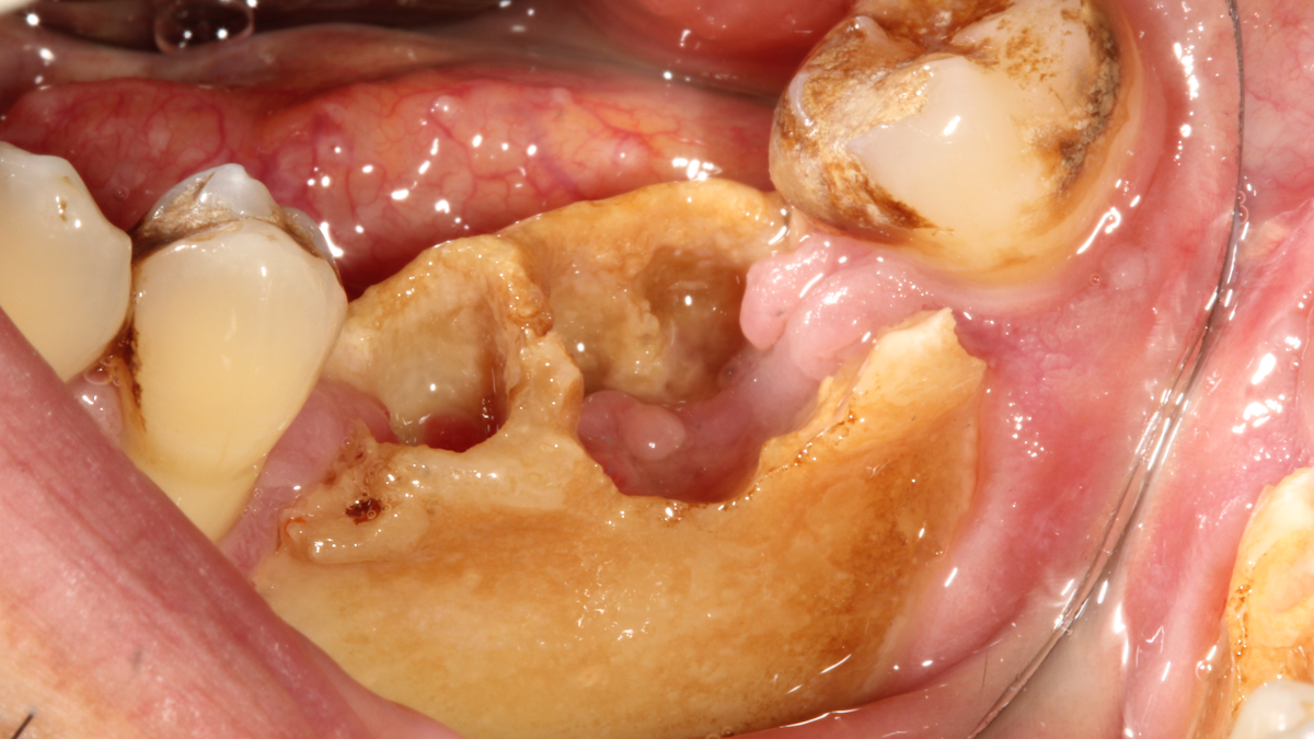 Risks of medication-related osteonecrosis of the jaw in cancer patients
