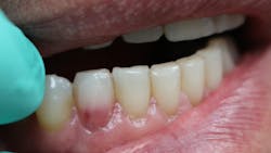 Figure 1: Lightly discolored “pink spot.” Figure 1: Lightly discolored “pink spot.”