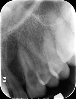 Figure 2: An example of internal resorption. Note the loss of the canal space with the resorptive defect. Figure 2: An example of internal resorption. Note the loss of the canal space with the resorptive defect.