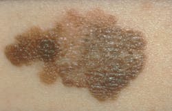 Figure 1: A = Asymmetry Figure 1: A = Asymmetry