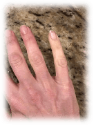 Examples of Raynaud's syndrome Examples of Raynaud's syndrome