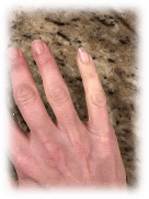 Examples of Raynaud&apos;s syndrome
