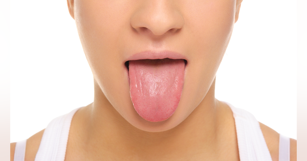 Split tongue healing