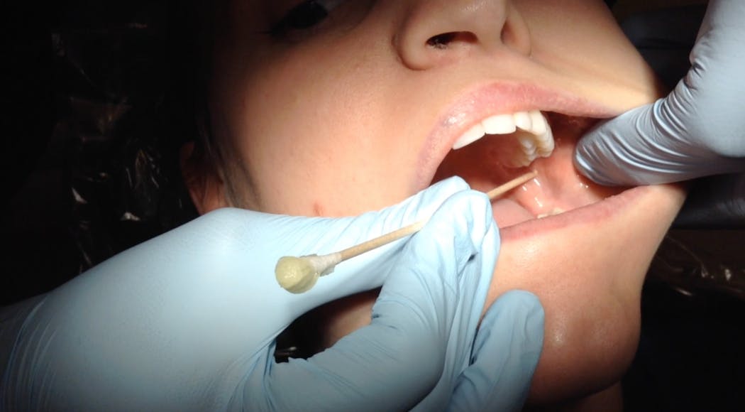 Figure 3: This patient demonstrates an unusually high coronoid notch location; thus, the clinician is positioning the penetration site significantly higher than typically observed.