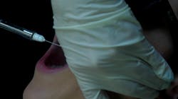 Figure 5: Approximating an imaginary line from the intertragic notch to the labial commissure through the armamentarium barrel. Figure 5: Approximating an imaginary line from the intertragic notch to the labial commissure through the armamentarium barrel.