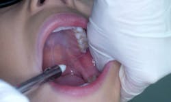 Figure 6: Approximation of the intraoral landmark noted just under the mesiolingual cusp of the maxillary second molar, with an &ldquo;aim high&rdquo; approach to the contralateral barrel positioning.