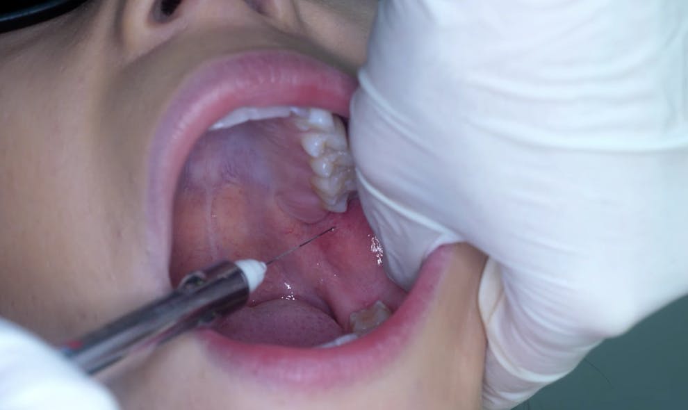 Figure 6: Approximation of the intraoral landmark noted just under the mesiolingual cusp of the maxillary second molar, with an &ldquo;aim high&rdquo; approach to the contralateral barrel positioning.