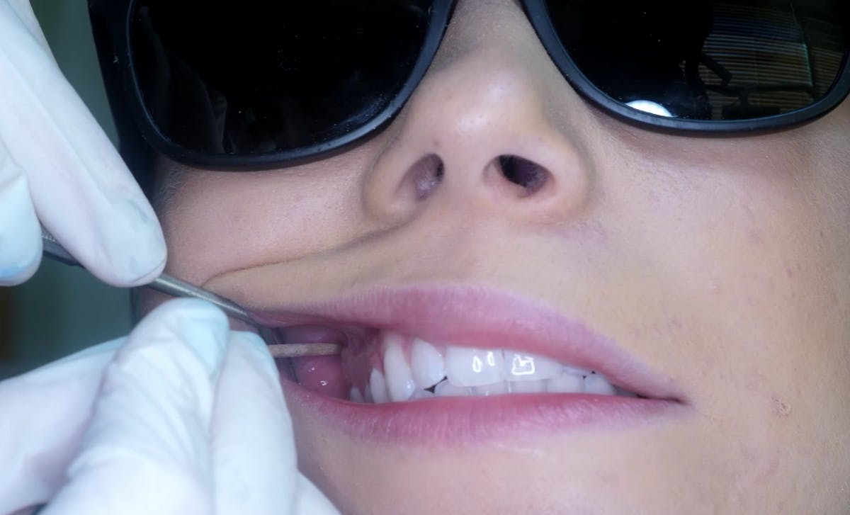 Stay SHARP with mandibular injection techniques | Registered Dental ...