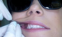 Figure 7: Identification of height noted by utilizing the mucogingival junction of the maxillary molars, identifying a point adjacent to the maxillary tuberosity. Figure 7: Identification of height noted by utilizing the mucogingival junction of the maxillary molars, identifying a point adjacent to the maxillary tuberosity.