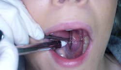 Figure 9: Initial penetration for the mylohyoid nerve block. The clinician has located the point distal to the apex of the mesial root of the most posterior molar in the mandibular quadrant. Figure 9: Initial penetration for the mylohyoid nerve block. The clinician has located the point distal to the apex of the mesial root of the most posterior molar in the mandibular quadrant.