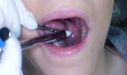 Figure 10: Depth and angle for the mylohyoid nerve block. The clinician has met gentle bony resistance in the angle of the mandible. Figure 10: Depth and angle for the mylohyoid nerve block. The clinician has met gentle bony resistance in the angle of the mandible.