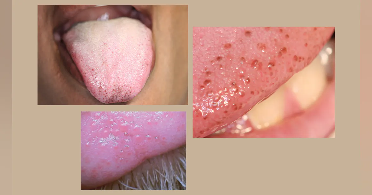 Pigmented fungiform papillae, or papillary tip melanosis | Registered Dental Hygienists Pigmented fungiform papillae, or papillary tip melanosis | Registered Dental Hygienists