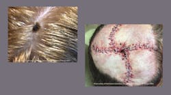 A melanoma lesion on the top of a patient&apos;s head (left). Closure of the surgical area on the patient&apos;s scalp after Moh&apos;s surgery to remove the melanoma and clear margins (left).