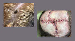 A melanoma lesion on the top of a patient's head (left). Closure of the surgical area on the patient's scalp after Moh's surgery to remove the melanoma and clear margins (left).
