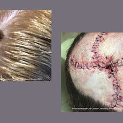 A melanoma lesion on the top of a patient&apos;s head (left). Closure of the surgical area on the patient&apos;s scalp after Moh&apos;s surgery to remove the melanoma and clear margins (left).