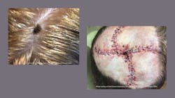 A melanoma lesion on the top of a patient's head (left). Closure of the surgical area on the patient's scalp after Moh's surgery to remove the melanoma and clear margins (left). A melanoma lesion on the top of a patient's head (left). Closure of the surgical area on the patient's scalp after Moh's surgery to remove the melanoma and clear margins (left).