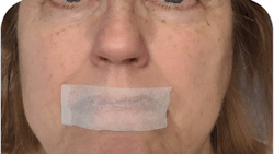 What mouth taping may look like. What mouth taping may look like.