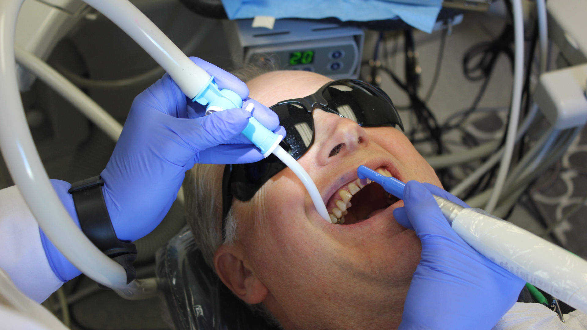 Hill polishing with the Young Infinity handpiece, using the Dove Aero&circledR; HVE saliva ejector - large barb connection. It&rsquo;s disposable and offers additional aerosol control.