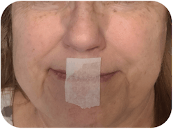 Figure 2: To practice mouth taping for sleep, fold the end of the tape over 2 to 3 mm (top). Then either tape from philtrum to chin (middle), or commisure to commisure (bottom). One-inch paper tape shown. Figure 2: To practice mouth taping for sleep, fold the end of the tape over 2 to 3 mm (top). Then either tape from philtrum to chin (middle), or commisure to commisure (bottom). One-inch paper tape shown.