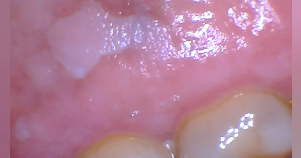 tobacco leukoplakia How do you treat leukoplakia? Oral leukoplakia - Smarty PANCE