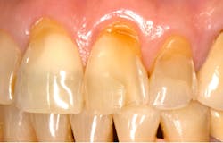 Figure 2: Erosive tooth wear related to sucking lemons
