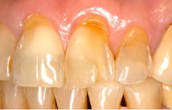 Figure 2: Erosive tooth wear related to sucking lemons Figure 2: Erosive tooth wear related to sucking lemons
