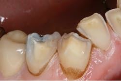 Figure 3: Erosive tooth wear related to acid erosion plus severe bruxism