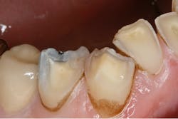 Figure 3: Erosive tooth wear related to acid erosion plus severe bruxism Figure 3: Erosive tooth wear related to acid erosion plus severe bruxism