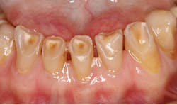 Figure 5: Severe erosion related to xerostomia Figure 5: Severe erosion related to xerostomia