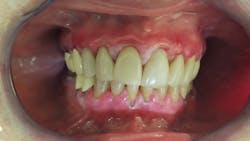 Figure 1: Lichen planus pemphigoides. Note the inflammation. Figure 1: Lichen planus pemphigoides. Note the inflammation.