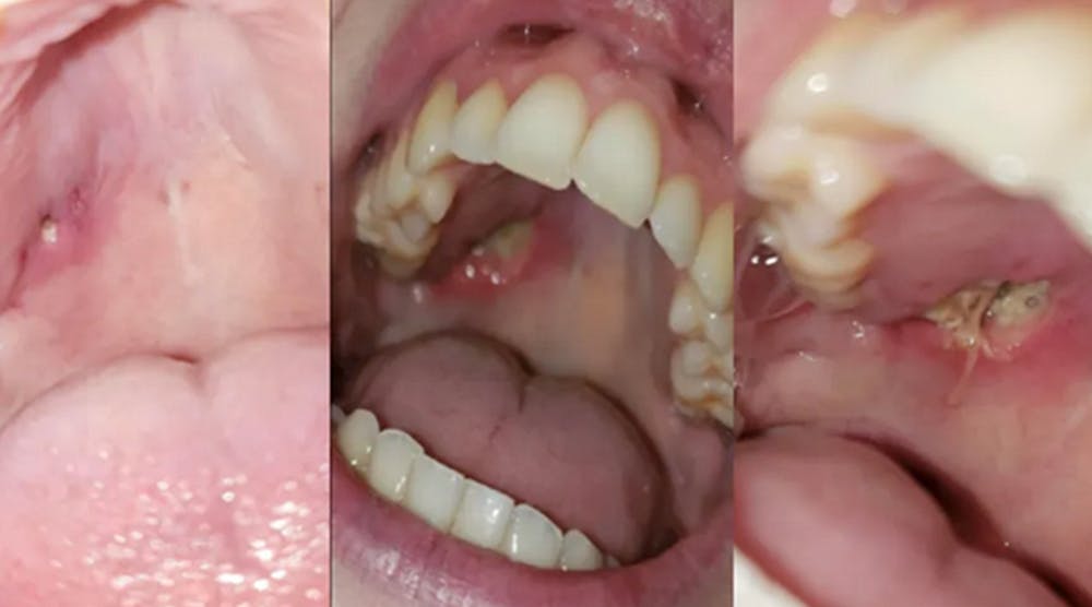 Figure 1: Intraoral photo (left) prior to seeing a general dentist. Pt. experienced three small holes in soft palate. General dentist referred to oral surgeon. The three small holes expanded into one large hole (center) before oral surgeon could be seen. Oral surgeon diagnosed necrotic tissue and took biopsy that confirmed Wegener&apos;s Granulomatosis diagnosis. After the biopsy, stitches were placed (right).