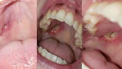 Figure 1: Intraoral photo (left) prior to seeing a general dentist. Pt. experienced three small holes in soft palate. General dentist referred to oral surgeon. The three small holes expanded into one large hole (center) before oral surgeon could be seen. Oral surgeon diagnosed necrotic tissue and took biopsy that confirmed Wegener's Granulomatosis diagnosis. After the biopsy, stitches were placed (right). Figure 1: Intraoral photo (left) prior to seeing a general dentist. Pt. experienced three small holes in soft palate. General dentist referred to oral surgeon. The three small holes expanded into one large hole (center) before oral surgeon could be seen. Oral surgeon diagnosed necrotic tissue and took biopsy that confirmed Wegener's Granulomatosis diagnosis. After the biopsy, stitches were placed (right).