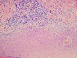Figure 2: Characteristic histologic features of lichen planus with a superficial bandlike infiltrate showing degeneration of the basal cells with areas exhibiting mild thickening of the basal cell layer. Figure 2: Characteristic histologic features of lichen planus with a superficial bandlike infiltrate showing degeneration of the basal cells with areas exhibiting mild thickening of the basal cell layer.