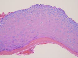 Figure 3: One area of the specimen shows a complete separation from the underlying connective tissue and well-preserved basal cells.