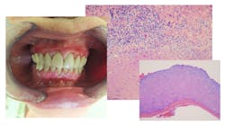 Lichen Planus Pemphigoides Lichen Planus Pemphigoides