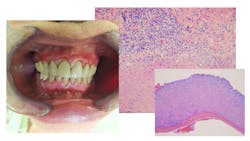 Lichen Planus Pemphigoides 61bba2ed490b9 Lichen Planus Pemphigoides 61bba2ed490b9
