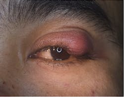 Figure 2: Orbital cellulitis Figure 2: Orbital cellulitis