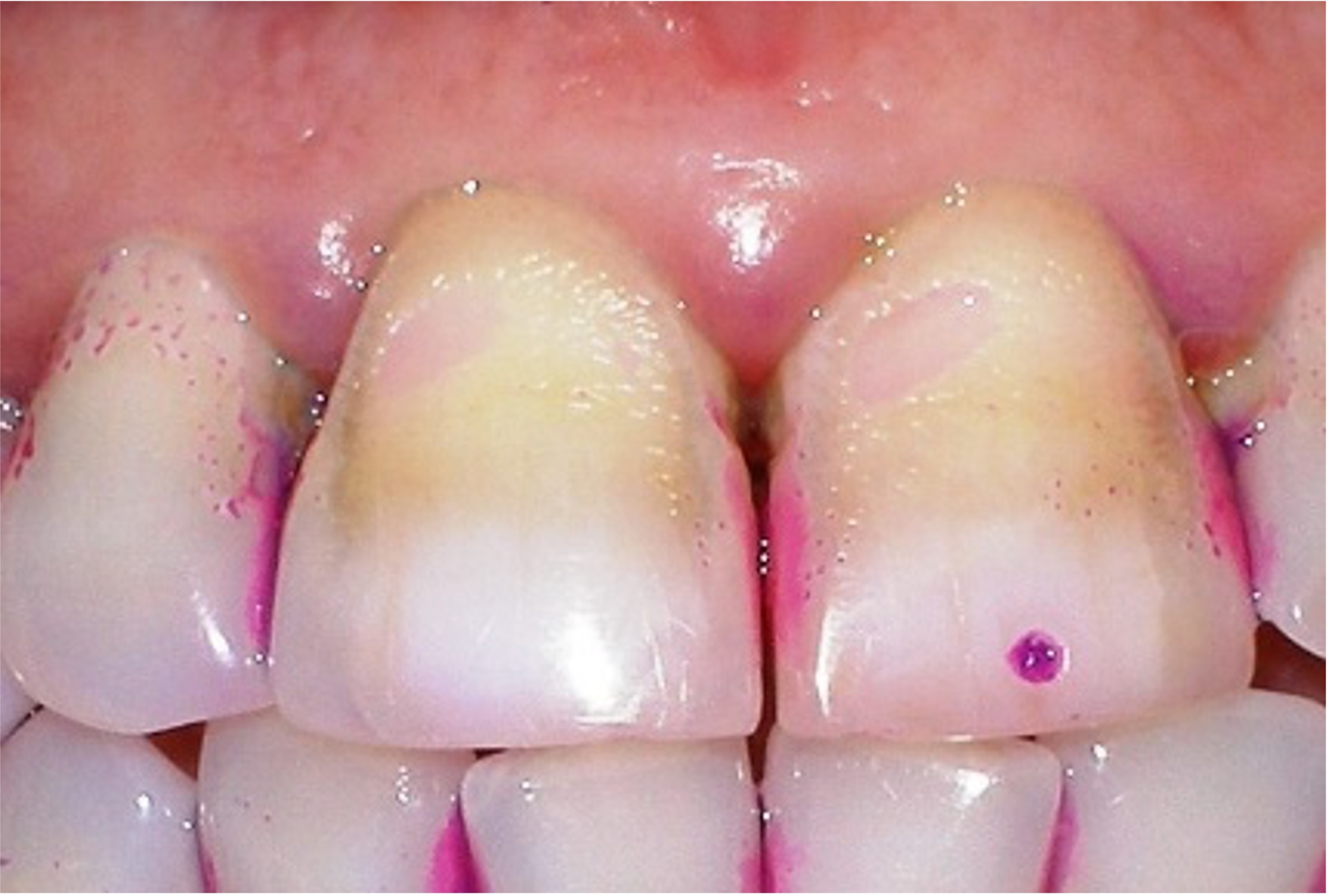 Tooth And Gum Scraping Negative Stain