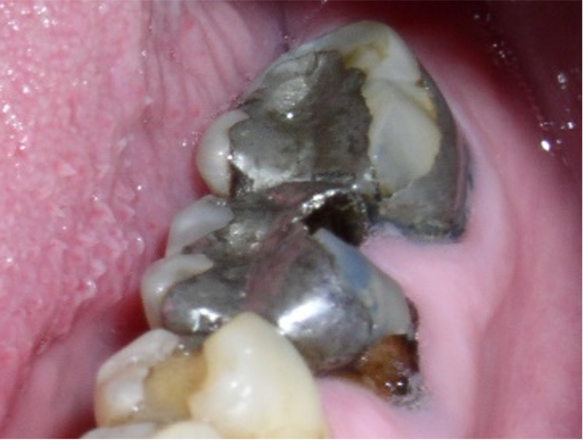Tooth And Gum Scraping Negative Stain