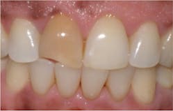 Figure 5: Pulpless tooth discoloration