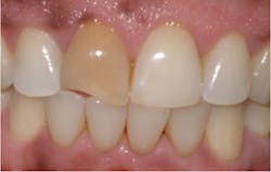 Figure 5: Pulpless tooth discoloration Figure 5: Pulpless tooth discoloration