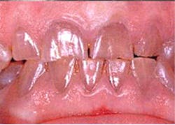Figure 6: Dentinogenesis imperfecta