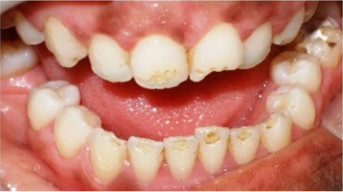 Spotted Teeth Removing stains from teeth: A guide for clinicians and patients ...